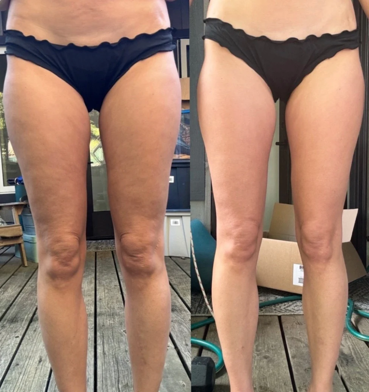 Revive Cellulite Remover