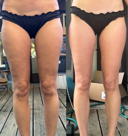 Revive Cellulite Remover